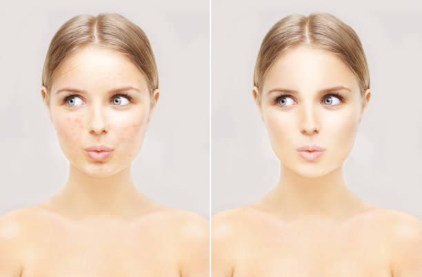 peeling acné antes y después